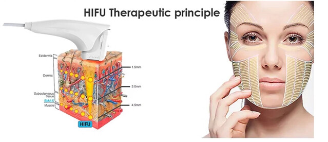 Hifu Machine: Revolutionizing Ultrasound Thermal Therapy